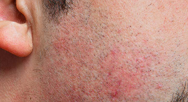 RAZOR BURN & ITCHING