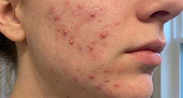 ACNE & OIL CONTROL